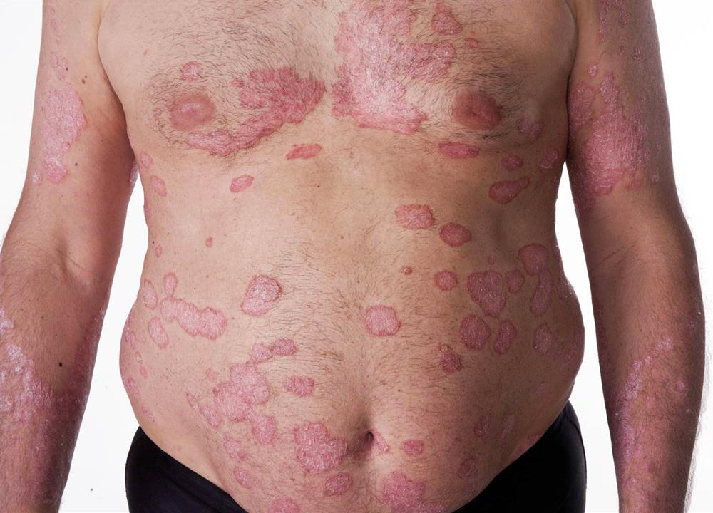 Psoriasis