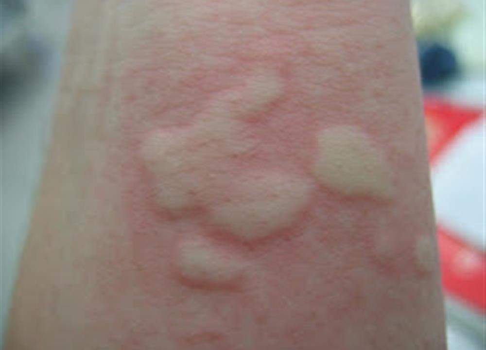 Urticaria