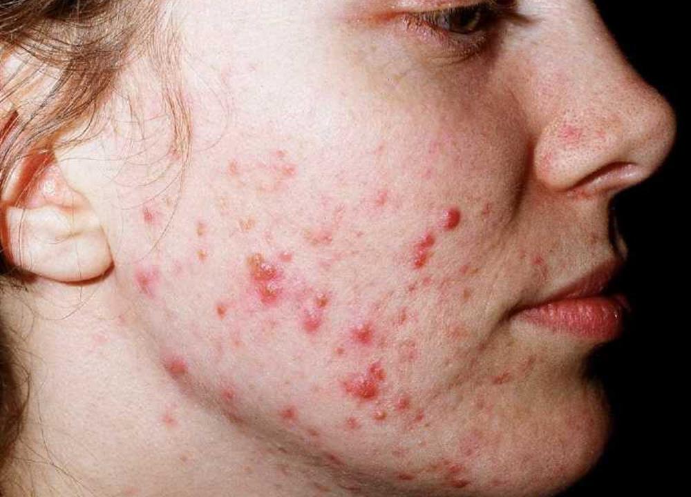 Acne Vulgaris