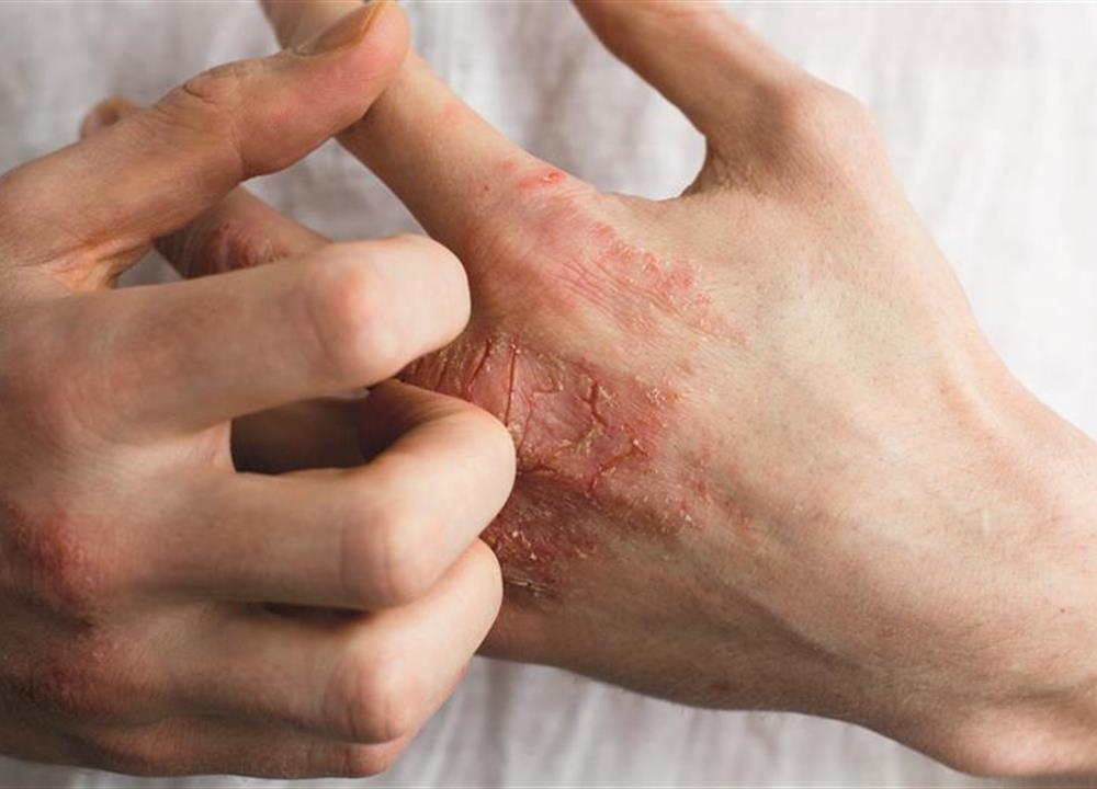 Skin Diseases